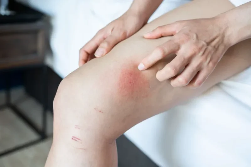 Why Chafing Rash Happens and What You Can Do to Stop It